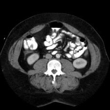 contrast enhanced abdominal CT